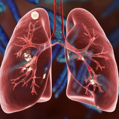 Precio De Consulta De Colocacion De Drenaje Pleural En Cdmx